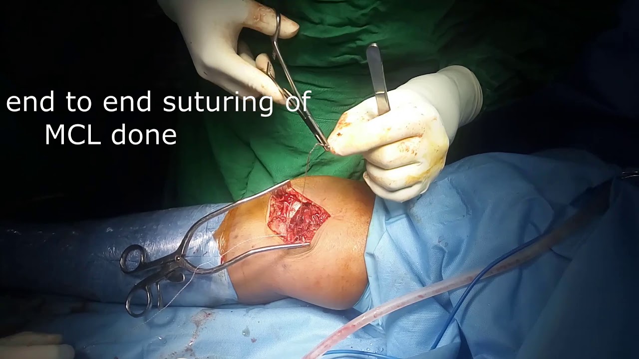 medial collateral ligament repair - YouTube