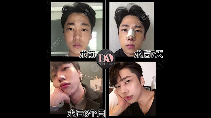 【韩国DA整形】鼻子是打了玻尿酸？还是隆鼻了？ - 天天要闻