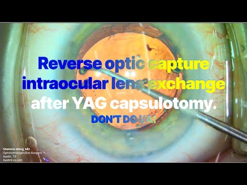 LEARN FROM MY MISTAKE!  Reverse optic capture intraocular lens exchange after YAG Capsulotomy.