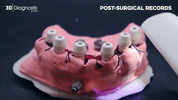 Utilizing OPTISPLINT® for All-on-X Restoration Records (GFMP – FMP) | 3DDX Digital Workflow