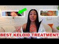 Get Rid of Your Keloids | QUICKEST and SAFEST Solution