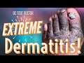 Extreme Dermatitis (With A Gooey Fungal Toenail)
