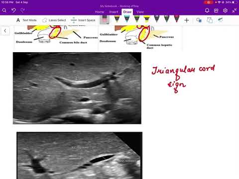 Biliary atresia radiology