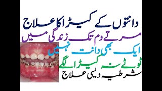 Tooth Worm Cavity Remove Treatment / Danton Ke Keeday ka Katama / دانتوں کا کیڑالگنےکی وجہ اور علاج