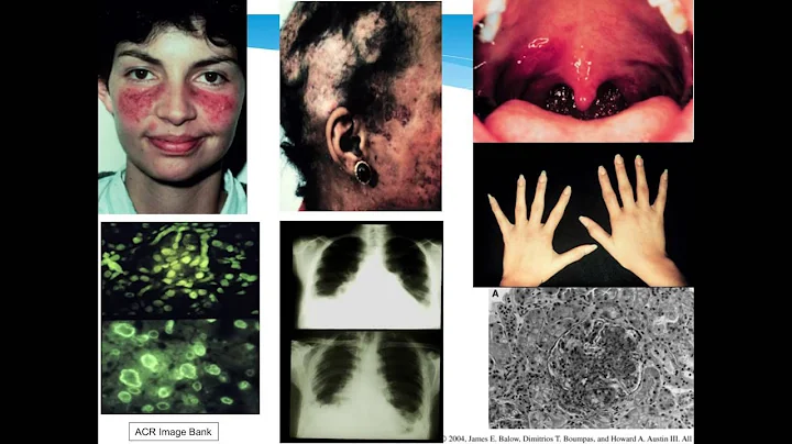 Rosalind Ramsey Goldman, MD, DrPh Presents "Rheuma...