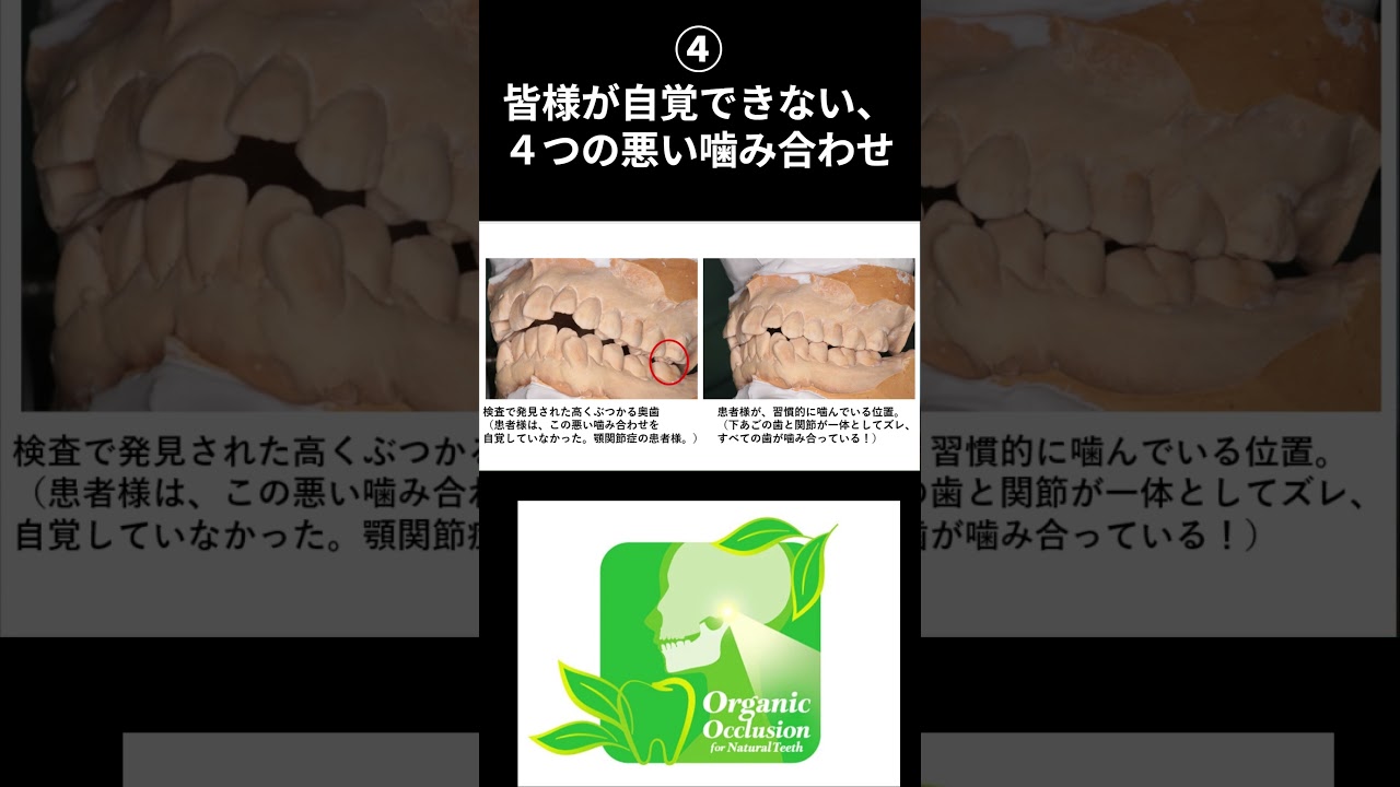 ④皆様が自覚できない4つの悪い噛み合わせ #噛み合わせ #顎関節