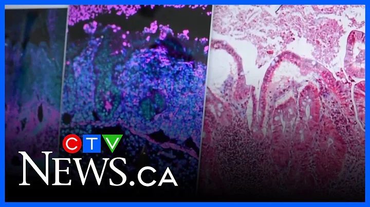 New AI analysis leads to scientific breakthrough in treatment of Crohn’s disease