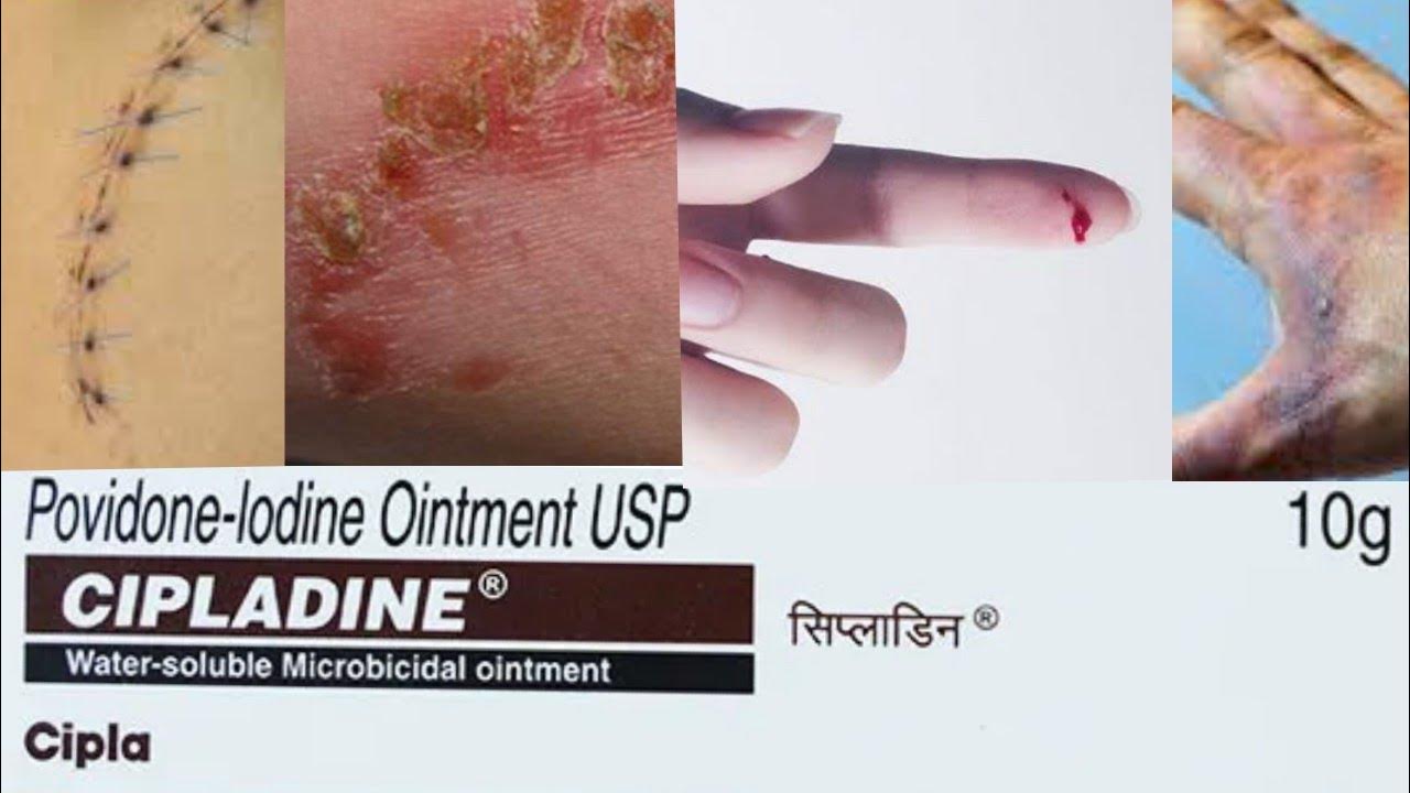 Cuts,Wounds,Burns,Infections,Dressing,Circumcision Cipladine