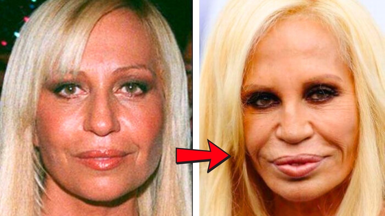 Plastic Surgery Gone WrongHollywood's Most Shocking Transformations