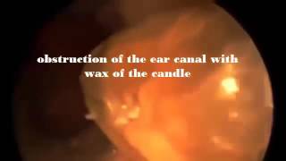 The biggest Ear Wax Removal