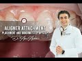 Aligner attachment placement and bonding step by step- aligner delivery -invisalign
