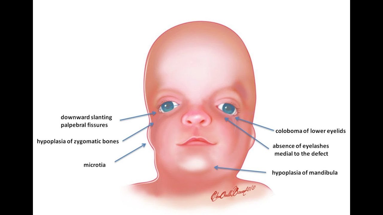 Overview of Mandibular Facial Dysostosis or Treacher collins syndrome