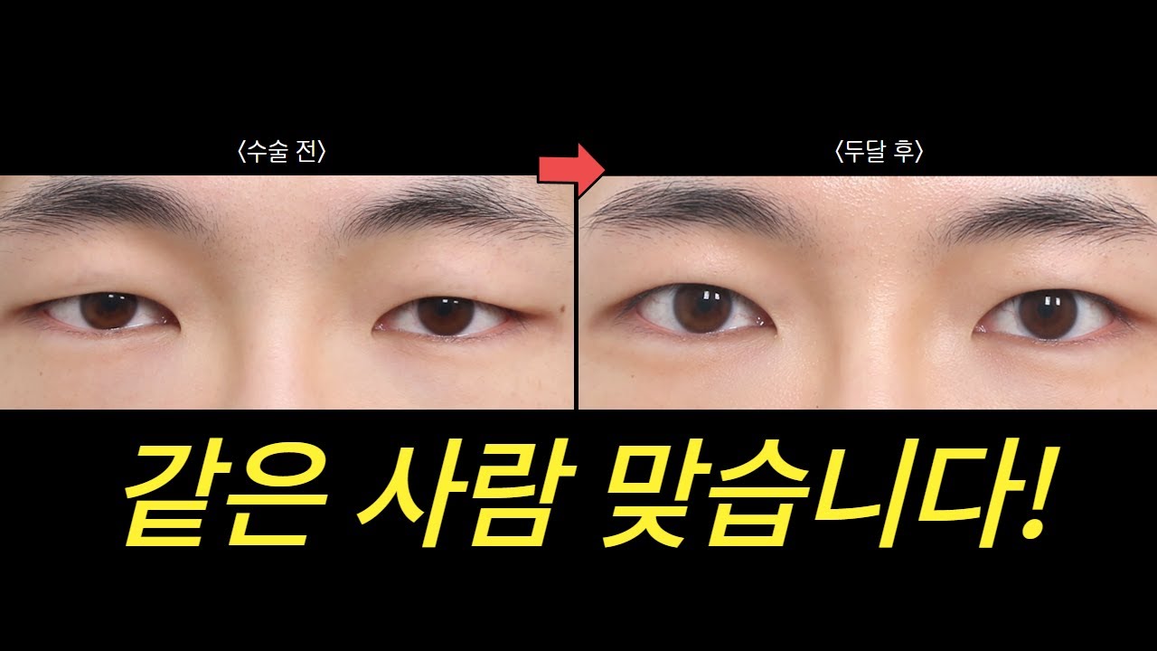 [Вондерфул гоо сайхны мэс засал] Эрэгтэй хүний нүдийг байгалиас заяасан мэт тод, сэргэг харагдуулах боломжтой!! | Давхраа үүсгэхгүйгээр нүдний хэлбэр засвар