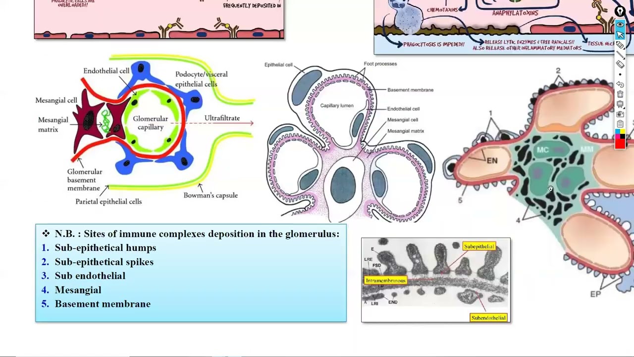 3-Glomerulonephritis; Nephrotic & Nephritic syndrome شرح باطنة دكتور سويلم