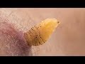 Researcher raises botflies under his skin I NOVA I PBS