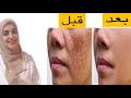 وصفه لازاله الكلف و التخلص من التصبغات العميقة و البقع الداكنه في الوجه 