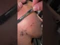 Derma removal