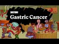 Gastric Cancer: Risk Factors, Diagnosis & Management (Part 1) | Sketchy Medical  | USMLE Step 2 CK