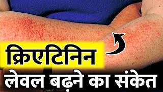 क्रिएटिनिन बढ़ने के लक्षण | Creatinine Treatment  | Kidney creatinine treatment