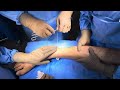 Tendon transfer surgery in foot drop | फुट ड्राप का इल्लाज़ | बेस्ट फुट एंड एंकल सर्जन इन इंडिया .