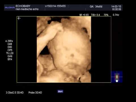 3D echo 34 weken zwanger