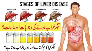 Jigar Kharab Hone Ki Wajah | Liver Diseases | Top Signs Of Fatty Liver | Liver Causes And Treatment