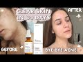 I FINALLY cleared my skin with The Ordinary products *BEST ACNE OUT SKINCARE ROUTINE*