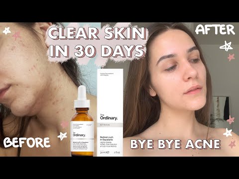 i-finally-cleared-my-skin-with-the-ordinary-products-*best-acne-out-skincare-routine*
