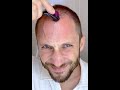 How I Use DermaRoller for Hair Growth and To Solve my Baldness and Hair Loss Tutorial 4k