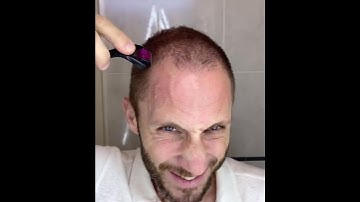 How I Use DermaRoller for Hair Growth and To Solve my Baldness and Hair Loss Tutorial 4k