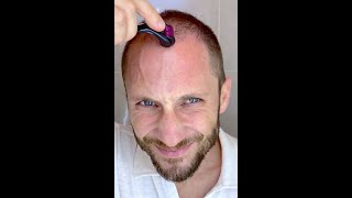 How I Use DermaRoller for Hair Growth and To Solve my Baldness and Hair Loss Tutorial 4k screenshot 1