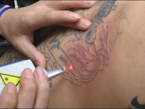 laser tattoo removal in andheri mumbai india alluremedspa youtube laser tattoo removal in andheri mumbai india alluremedspa youtube