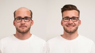 Sofortlösung bei Haarausfall mit Haarsystem | Haar Transformation | Hairsystems Heydecke