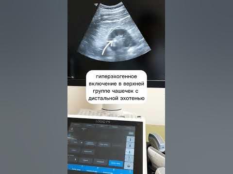 УЗИ ПОЧЕК. КАМЕНЬ В ПОЧКЕ - YouTube