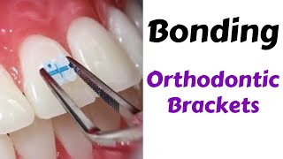 Step by Step #Orthodontic Brackets Bonding Technique MBT  orthodontic lecture