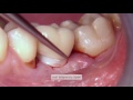 Place custom-made implant abutments and crowns with CEREC