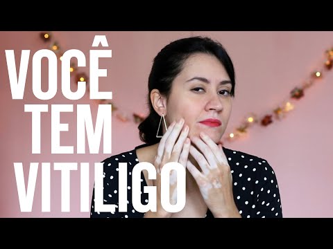 Vídeo: Estou Pronto Para Esconder Meu Vitiligo