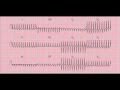 Reading the 12-lead ECG/EKG - six quick steps