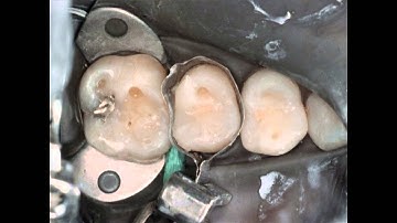 Maxillary 1st Bicuspid (#13) MO Light-Cured Composite  A Time Saving Technique