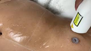 Fast Laser Hair Removal Pain Free