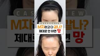 헤어라인이식에서 👉잔머리의 유무가 중요한 이유