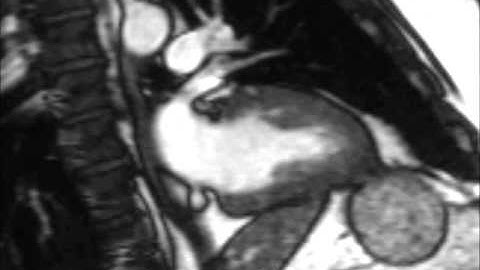 Cardiac MRI: Left ventricle and left atrium