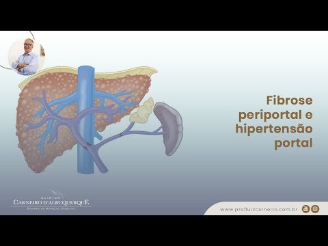 Fibrose periportal e hipertensão portal | Prof. Dr. Luiz Carneiro CRM 22761