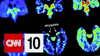 How CTE Can Affect The Brain