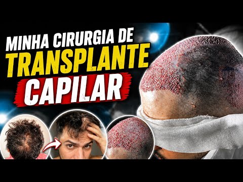 What is it like to have hair transplant surgery? Surgery day