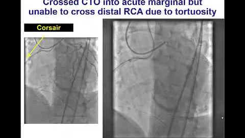 Balloon Uncrossable CTO