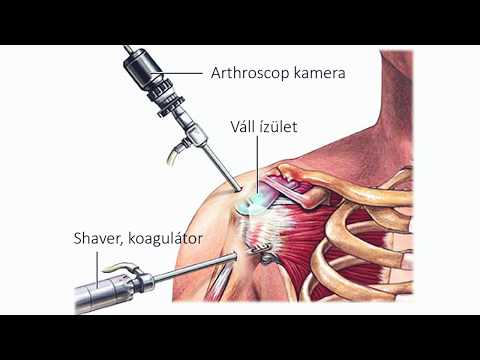 fájdalom a vállízület osteochondrozisában)