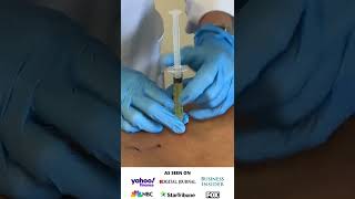 Platelet-rich plasma (PRP) injections at Peak Health in Kissimmee