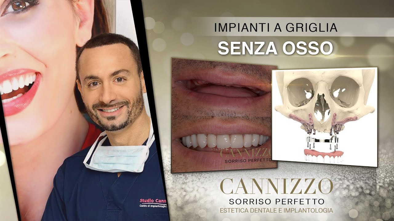 Impianti Dentali a Griglia - Cannizzo Studio