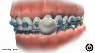 How to Use Wax for Orthodontic Comfort and Relief